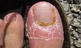 The treatment of nail fungus