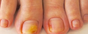 Most important symptoms and pictures onychomycosis