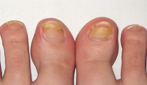 stages of nail fungus