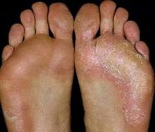 Foot with mycosis