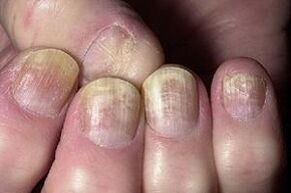 change in the nail with a fungal infection