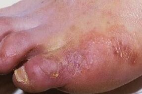 manifestations of fungal infection on the skin of the legs