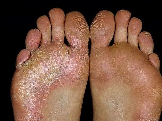 signs of fungus on the feet