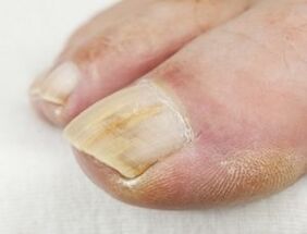 If there is pus near the nail, you can not use antifungal drops