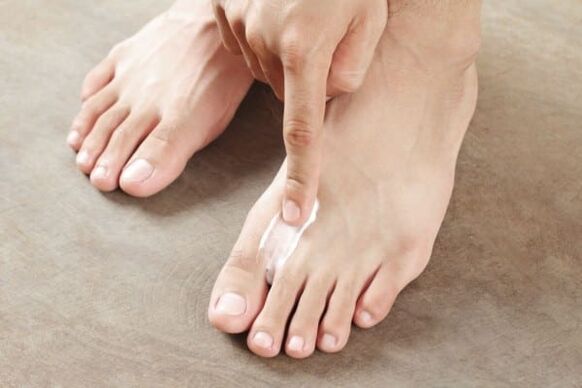 application of ointment from the fungus on the skin of the feet