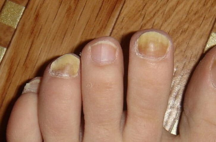 signs of fungus on the nails and skin of the feet