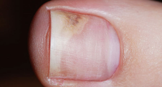 Symptoms in the early stages of onychomycosis