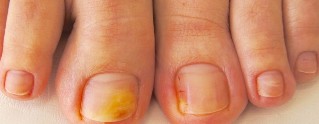 fungus toenails symptoms