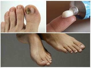 fungus toenails treatment