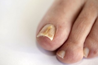 fungus toenails