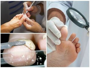 fungus foot skin diagnosis