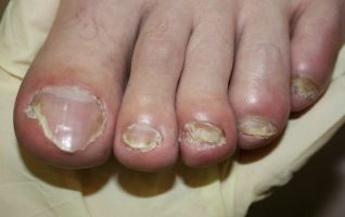 symptoms of nail fungus