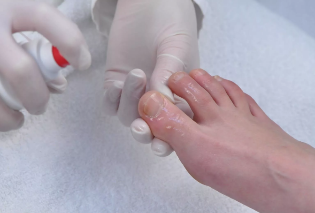 Start the treatment of nail fungus
