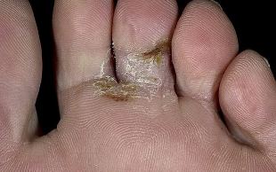 type of foot fungus