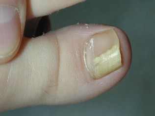 the fungus big toe